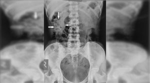 Los extraños casos de los bebés petrificados: Litopedia