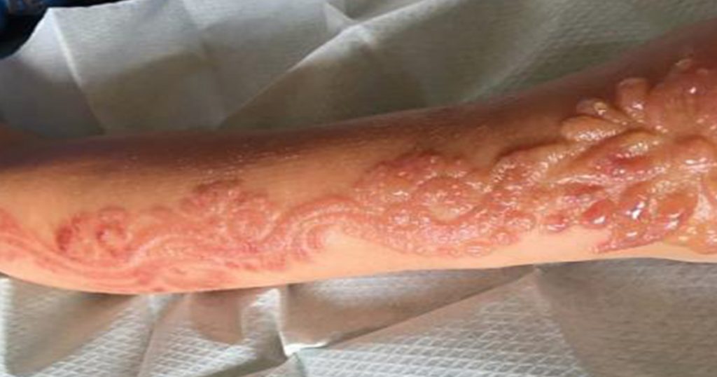¡Cuidado con los tatuajes de henna en los niños!
