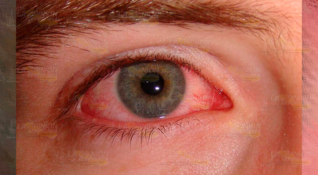 Brote de conjuntivitis azota a la comunidad FAMILIAS