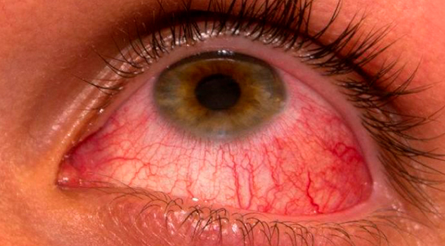 Norte y sur de Veracruz, con brotes de conjuntivitis: SS Norte Sur Veracruz Brotes Conjuntivitis