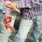 Se amputa la mano con una picadora de caña