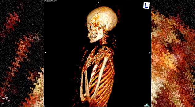 Encuentran dos casos de cáncer de mama en momias de Egipto