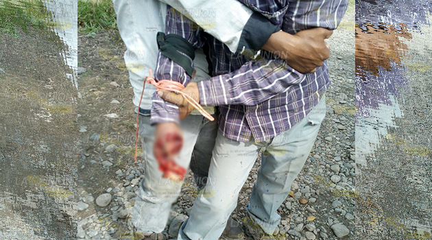 Se amputa la mano con una picadora de caña