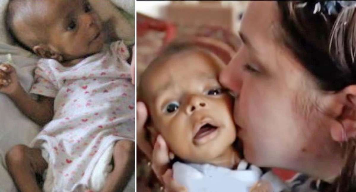 Una madre adoptó una niña huérfana y desnutrida. 2 años después se ve drásticamente diferente