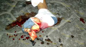 Taxi impacta a motociclista y le destroza el pie derecho Taxi Impacta Motociclista Destroza Pie Derecho