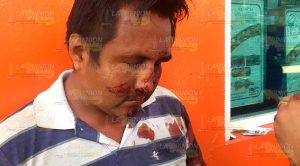 Ebrio pierde el equilibrio y se fractura la nariz Ebrio Pierde Equilibrio Fractura Nariz