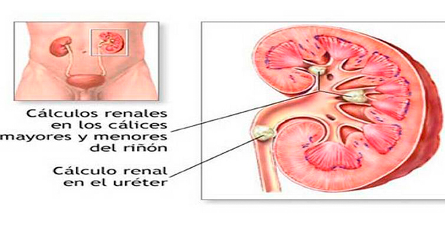 Cálculos o “piedras” en el riñón: litiasis renal