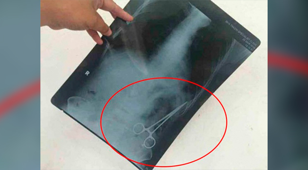 Vivió 26 años con 'tijera' alojada en su abdomen