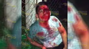 Brutal accidente en Cerro Azul; estudiante casi se saca un ojo Brutal accidente en Cerro Azul; estudiante casi se saca un ojo