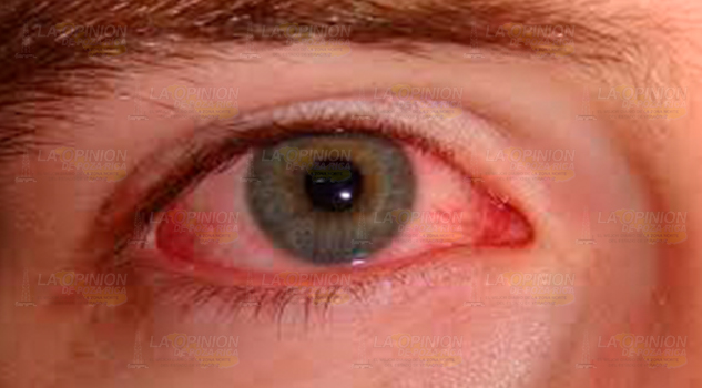 A tomar medidas, existen casos de conjuntivitis