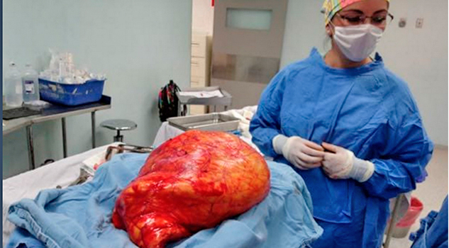 Médicos del IMSS realizan cirugía para retirar tumor de 17 kg