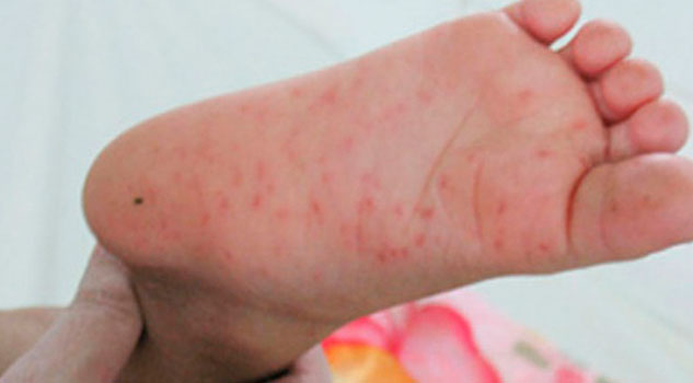 ¡Confirmado! Hay brote de virus Coxsackie en guardería de Querétaro ¡Confirmado! Hay brote de virus Coxsackie en guardería de Querétaro