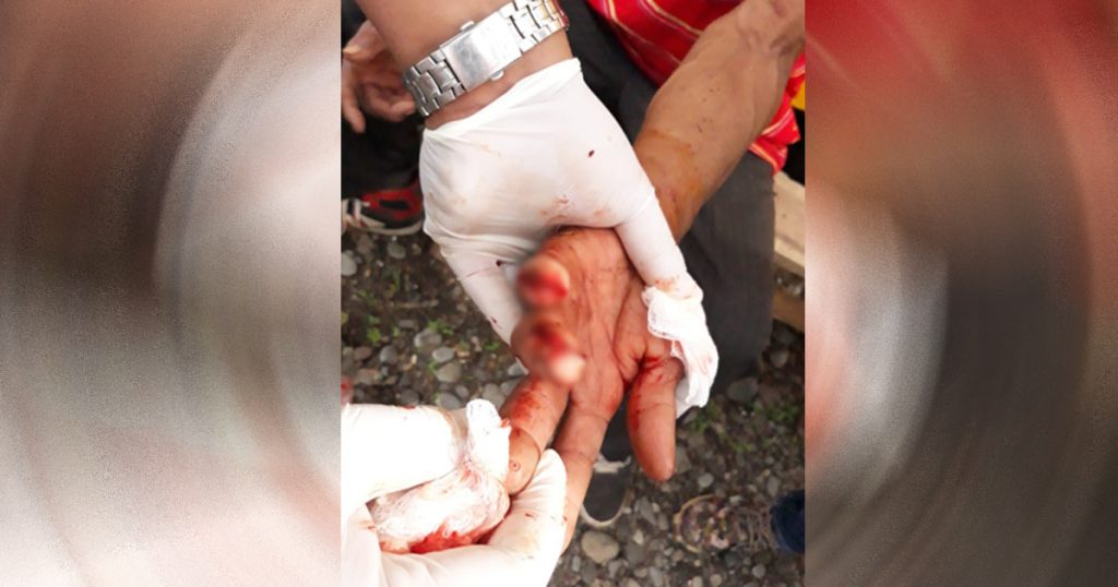 Casi se arranca los dedos con un machete en la Uno