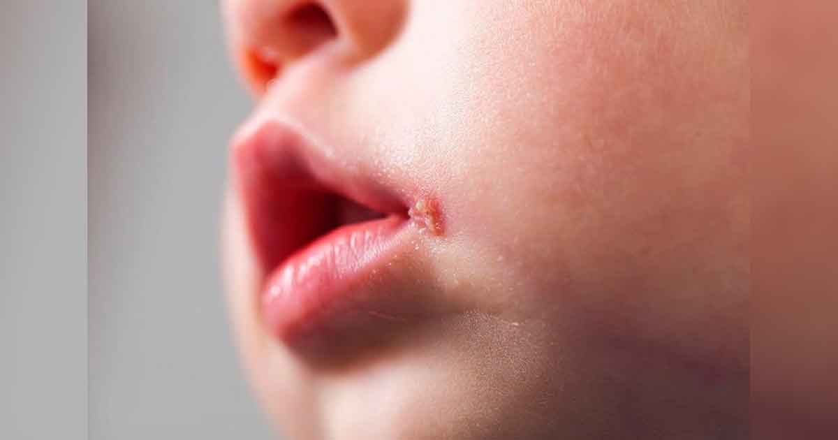 No beses a tus hijos en la boca; infección puede llegar a su cerebro