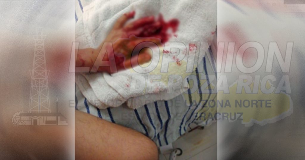 Podría perder la mano por falta de atención medica en el IMSS