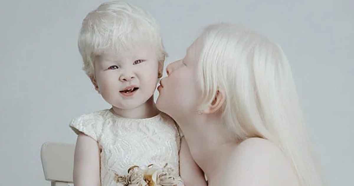 Estas hermanas albinas nos dejan sin palabras con su extraordinaria belleza