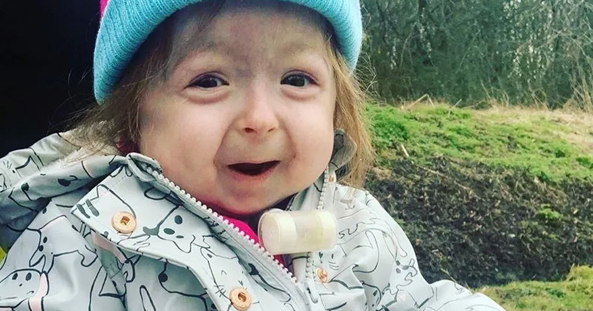 Niña de 2 años sufre la enfermedad de Benjamin Button