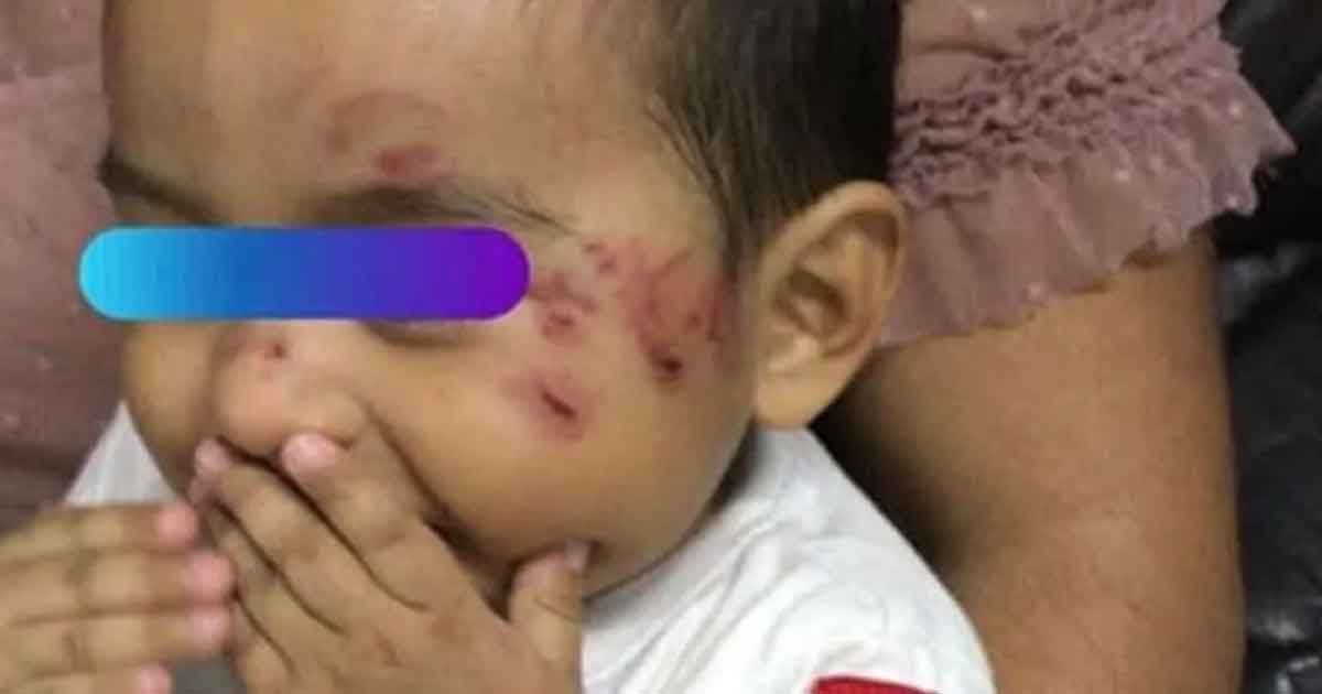 Atacan a mordidas a bebé en guardería de Coatzacoalcos