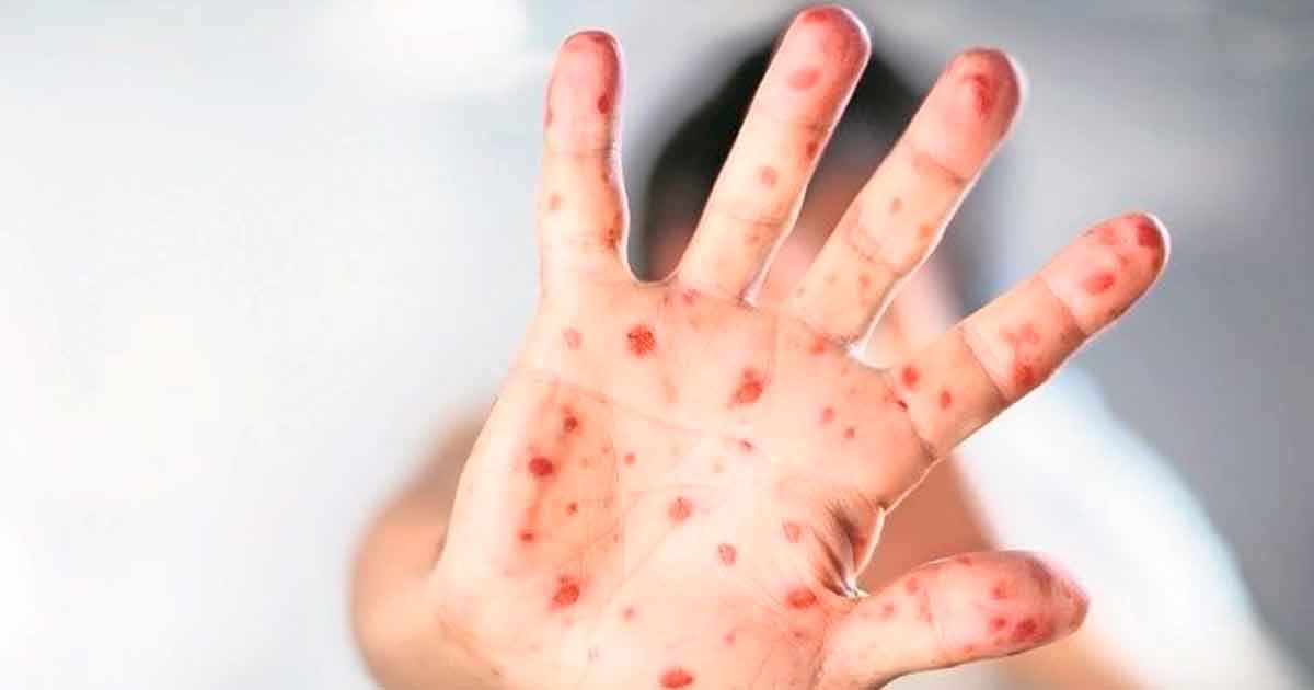 Casos de sarampión en México aumentan 2,725% en un mes