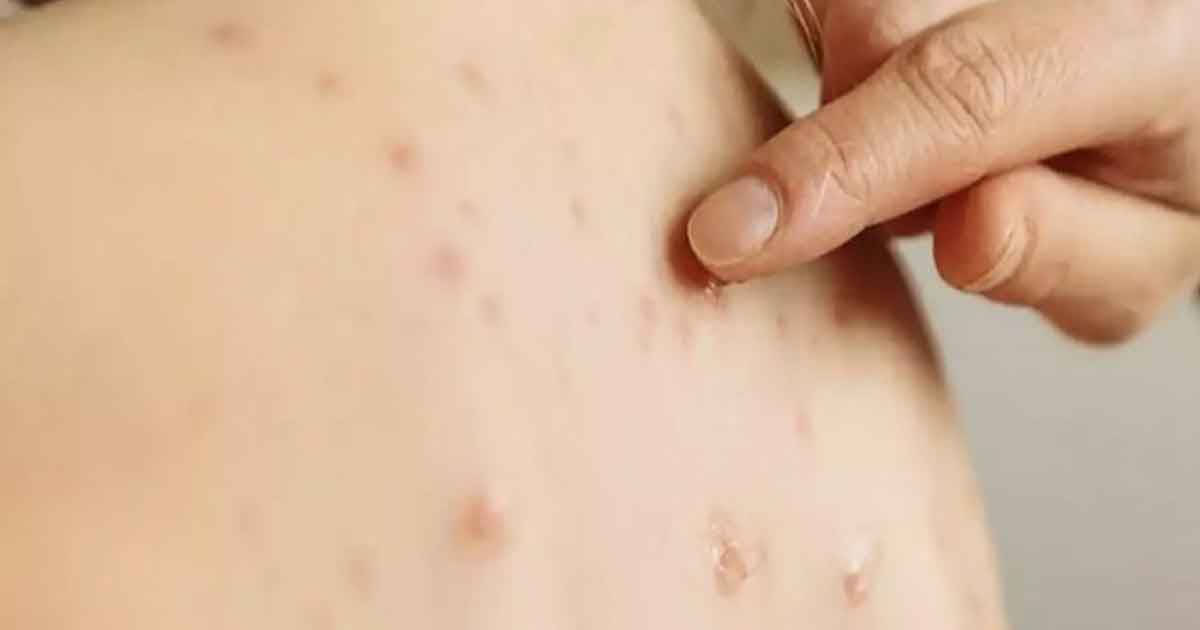 El sarampión y el dengue, las otras preocupaciones del sistema de salud