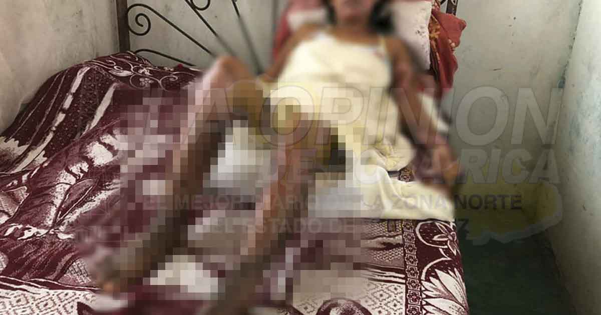 Mujer que sufrió quemaduras en tortillería, es ignorada por su patrón