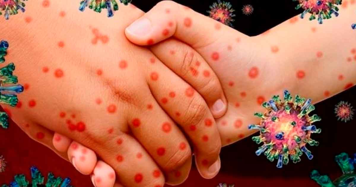 Sarampión incrementa número de contagios ahora hay 163 casos