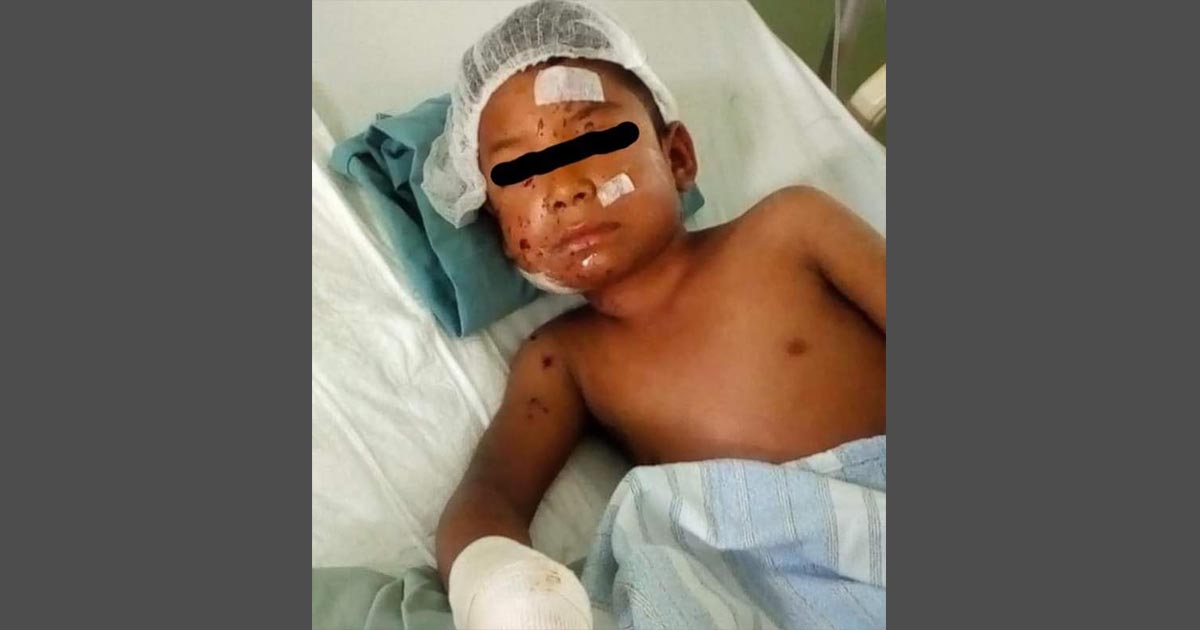 Niño de 9 años pierde la mano con pirotecnia
