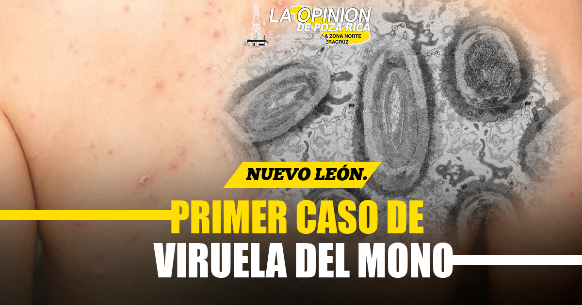 Reportan primer caso de viruela del mono en Nuevo León Reportan primer caso de viruela del mono en Nuevo León