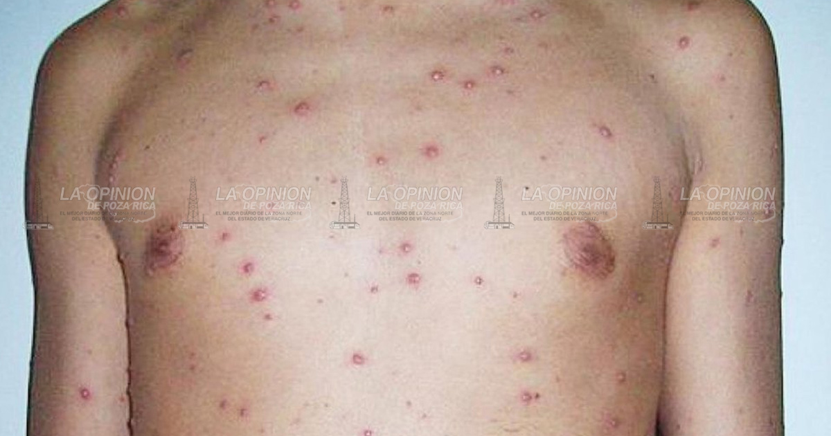 A abril, acumula Veracruz, 65 casos de viruela simica.