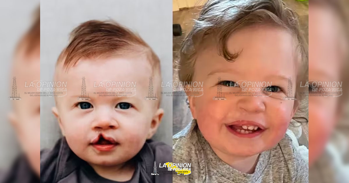 AC brindará operaciones gratuitas de labio leporino y paladar hendido en Medellín de Bravo