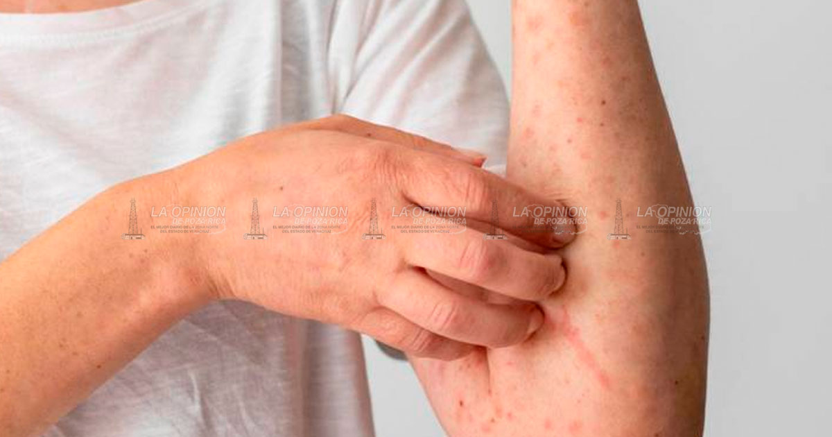 Brotan casos de rubéola y sarampión, alerta Salud