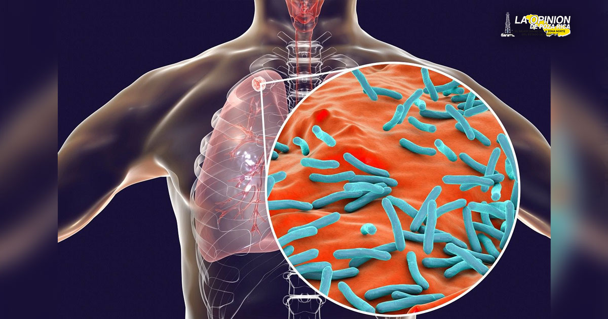 Advierten sobre Tuberculosis