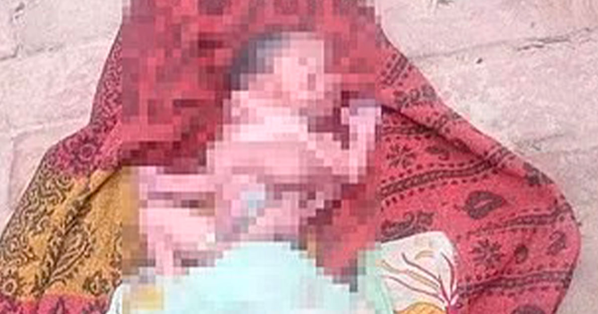 Bebé nace con cuatro piernas, cuatro brazos y dos caras