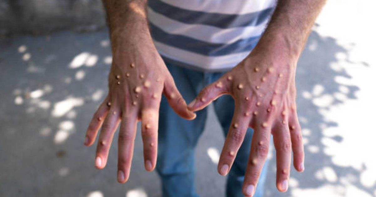 Veracruz registra 6 casos de Mpox