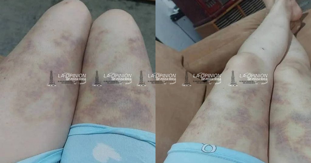 Fémina agredida por su pareja pide apoyo a gobernadora