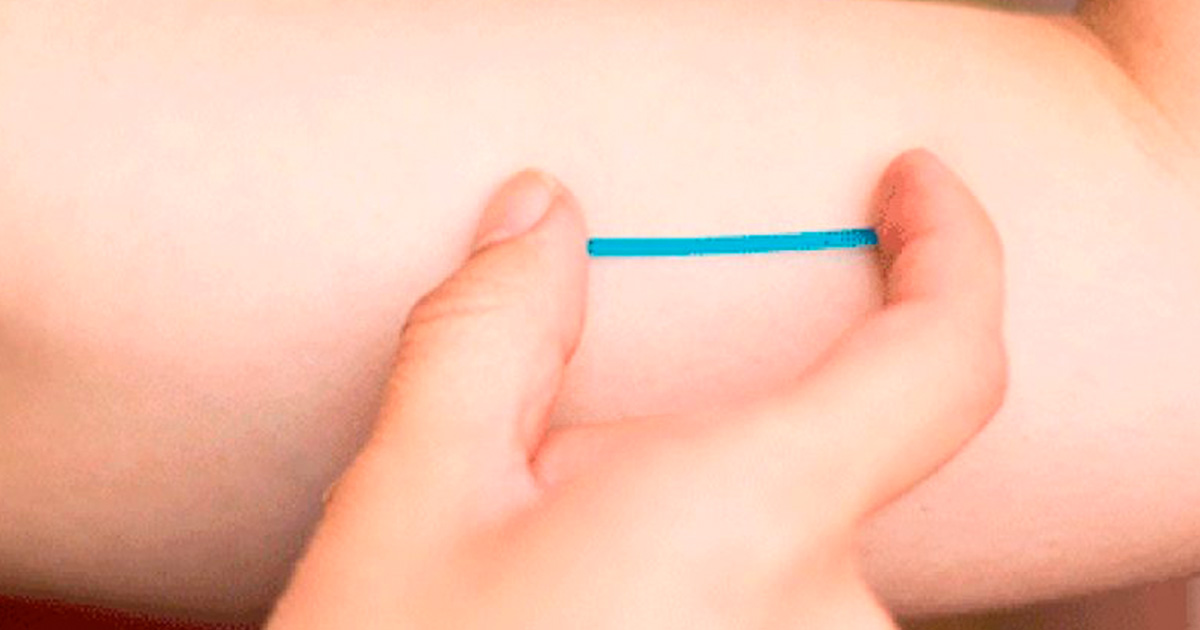 Retiran implantes subdérmicos gratis Retiran implantes subdérmicos gratis