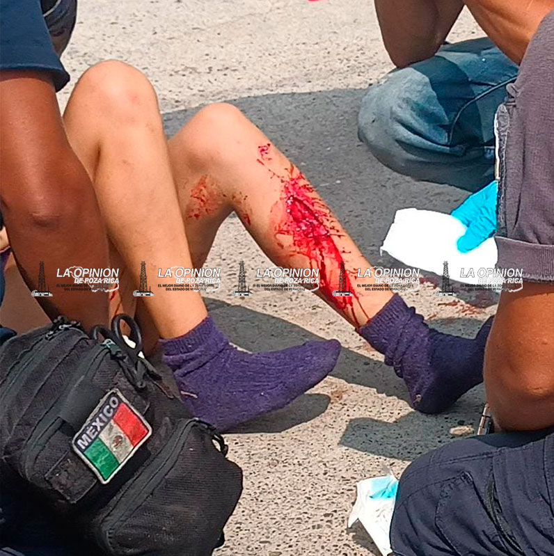Joven sufrió fractura al chocar en motocicleta Joven sufrió fractura al chocar en motocicleta