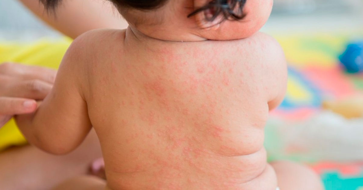 Sarampión causa la muerte de un bebé Sarampión causa la muerte de un bebé