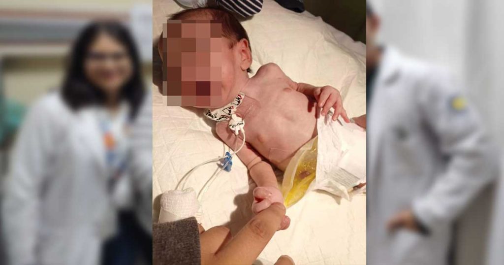 UMAE del IMSS en Veracruz Norte restablece tránsito intestinal de lactante con desnutrición severa